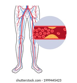 Peripheral Artery Disease Ischemia Leg Cholesterol Stock Vector ...