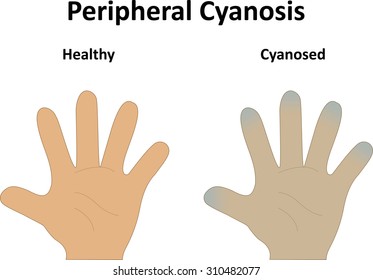 Peripheral Cyanosis