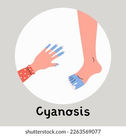 Peripheral cyanosis, cyanotic hand and foot. Low oxygen saturation, heart disease, partial obstruction, deep nervous symptom. Flat vector medical illustration.