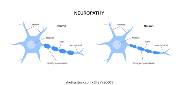 Peripheral neuropathy. Nerve fiber with damaged myelin sheath, revealing gaps and irregularities. Blue color highlight the affected areas, indicating impaired signal transmission, pain and weakness.