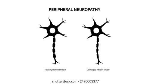 Peripheral neuropathy. Nerve fiber with a damaged myelin sheath, revealing gaps and irregularities. Affected areas, indicating impaired signal transmission, pain and weakness black icon.