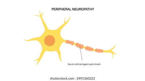 Peripheral neuropathy. Nerve fiber with a damaged myelin sheath, revealing gaps and irregularities. Highlight the affected areas, indicating impaired signal transmission, pain and weakness flat vector