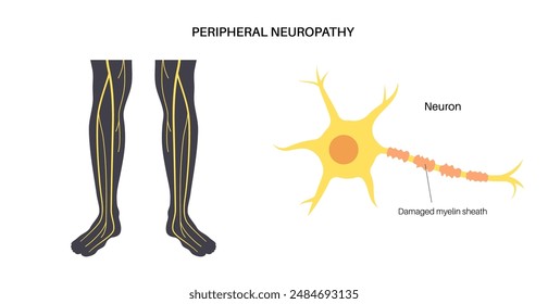 Peripheral neuropathy poster. Feet highlighted areas of pain, numbness, weakness and tingling. Diabetes or injury. Damaged nerves in the nervous system, myelin sheath deformity vector illustration