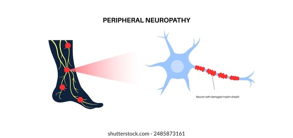 Peripheral neuropathy poster. Feet highlighted areas of pain, numbness, weakness and tingling. Diabetes or injury. Damaged nerve in the nervous system, myelin sheath deformity flat vector illustration