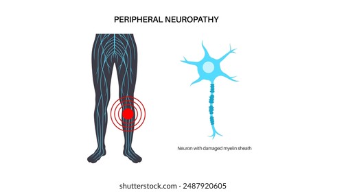 Peripheral neuropathy poster. Feet highlighted areas of pain, numbness, weakness and tingling. Diabetes or injury. Damaged nerve in the nervous system, myelin sheath deformity flat vector illustration