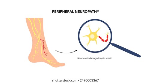 Peripheral neuropathy poster. Feet highlighted areas of pain, numbness, weakness and tingling. Diabetes or injury. Damaged nerve in the nervous system, myelin sheath deformity flat vector illustration