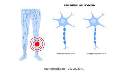 Peripheral neuropathy poster. Feet highlighted areas of pain, numbness, weakness and tingling. Diabetes or injury. Damaged nerve in the nervous system, myelin sheath deformity flat vector illustration