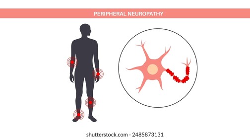 Peripheral neuropathy poster. Hands and feet highlighted areas of pain, numbness, and tingling. Diabetes or injury. Damaged nerves in the nervous system, myelin sheath deformity vector illustration