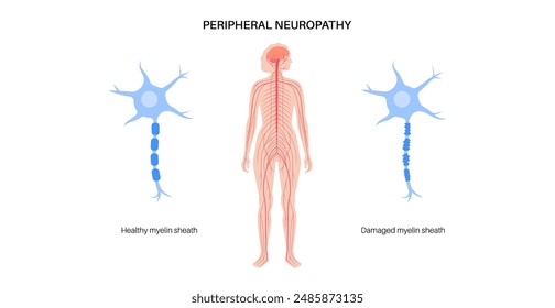 Peripheral neuropathy poster. Hands and feet highlighted areas of pain, numbness, and tingling. Diabetes or injury. Damaged nerves in the nervous system, myelin sheath deformity vector illustration