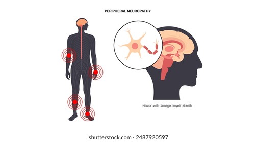 Peripheral neuropathy poster. Hands and feet highlighted areas of pain, numbness, and tingling. Diabetes or injury. Damaged nerves in the nervous system, myelin sheath deformity vector illustration