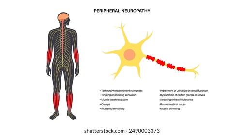 Peripheral neuropathy poster. Hands and feet highlighted areas of pain, numbness, and tingling. Diabetes or injury. Damaged nerves in the nervous system, myelin sheath deformity vector illustration