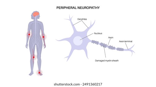 Cartel de neuropatía periférica. Las manos y los pies resaltaron áreas de dolor, entumecimiento y hormigueo. Diabetes o lesiones. Nervios dañados en el sistema nervioso, Ilustración vectorial por deformidad de la vaina de mielina