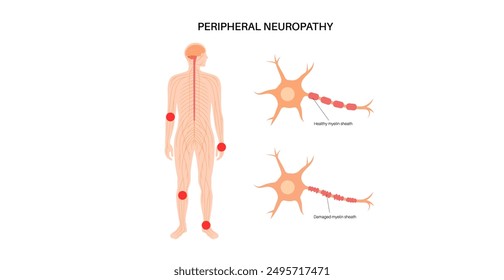 Peripheral neuropathy poster. Hands and feet highlighted areas of pain, numbness, and tingling. Diabetes or injury. Damaged nerves in the nervous system, myelin sheath deformity vector illustration