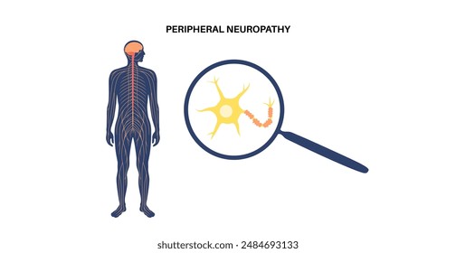 Peripheral neuropathy poster. Human brain and nerve fiber with a damaged myelin sheath, revealing gaps. Affected areas, indicating impaired signal transmission, pain and weakness vector illustration