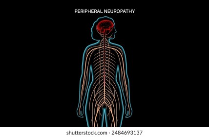 Peripheral neuropathy poster. Human brain and nerve fiber with a damaged myelin sheath, revealing gaps. Affected areas, indicating impaired signal transmission, pain and weakness vector illustration