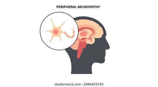 Peripheral neuropathy poster. Human brain and nerve fiber with a damaged myelin sheath, revealing gaps. Affected areas, indicating impaired signal transmission, pain and weakness vector illustration