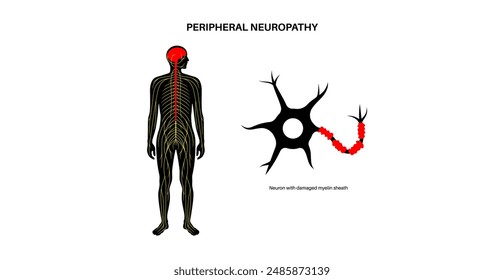 Peripheral neuropathy poster. Human brain and nerve fiber with a damaged myelin sheath, revealing gaps. Affected areas, indicating impaired signal transmission, pain and weakness vector illustration