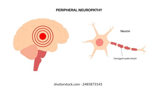 Peripheral neuropathy poster. Human brain and nerve fiber with a damaged myelin sheath, revealing gaps. Affected areas, indicating impaired signal transmission, pain and weakness vector illustration