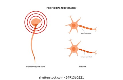 Peripheral neuropathy poster. Human brain and nerve fiber with a damaged myelin sheath, revealing gaps. Affected areas, indicating impaired signal transmission, pain and weakness vector illustration