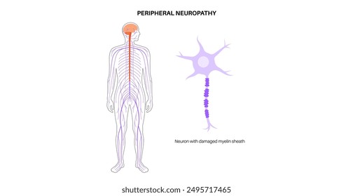 Peripheral neuropathy poster. Human brain and nerve fiber with a damaged myelin sheath, revealing gaps. Affected areas, indicating impaired signal transmission, pain and weakness vector illustration