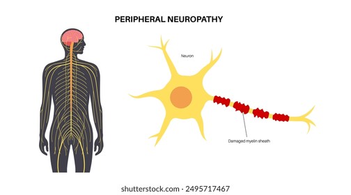 Peripheral neuropathy poster. Human brain and nerve fiber with a damaged myelin sheath, revealing gaps. Affected areas, indicating impaired signal transmission, pain and weakness vector illustration