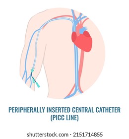 Peripherally inserted central catheter placed in the upper arm vein. Patient with PICC tube for medication and nutrition fluid delivery. Health care concept. Medical vector illustration.