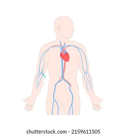 Peripherally inserted central catheter placed in the upper arm vein. Male patient with PICC tube for medication or nutrition fluid delivery. Health care concept. Medical vector illustration. 