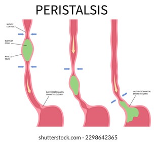 Peristalsis medical anatomy swallow eating achalasia problem hypermotility with hyperperistalsis Gas distension Nausea Bloated Burping hypomotility hypoperistalsis pain