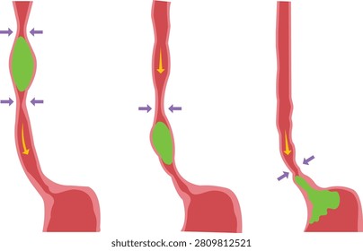 Peristalsis movement vector illustration set with anatomical diagram showing food bolus moving through the digestive tract