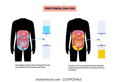 Procedimiento de diálisis peritoneal. Fluido en cavidad peritoneal. Peritoneo en el abdomen, las sustancias se intercambian con la sangre. Tubo suave en el cuerpo humano, concepto catéter. Eliminar el exceso de líquido del vientre