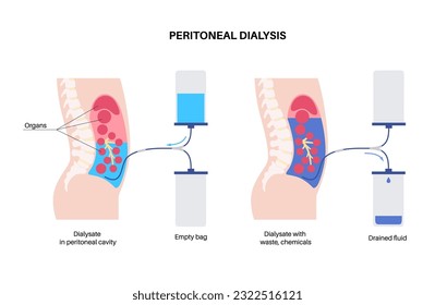 Procedimiento de diálisis peritoneal. Fluido en cavidad peritoneal. Peritoneo en el abdomen, las sustancias se intercambian con la sangre. Tubo suave en el cuerpo humano, concepto catéter. Eliminar el exceso de líquido del vientre