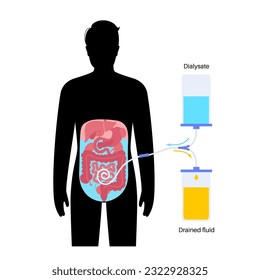 Procedimiento de diálisis peritoneal. Fluido en cavidad peritoneal. Peritoneo en el abdomen, las sustancias se intercambian con la sangre. Tubo suave en el cuerpo humano, concepto catéter. Eliminar el exceso de líquido del vientre