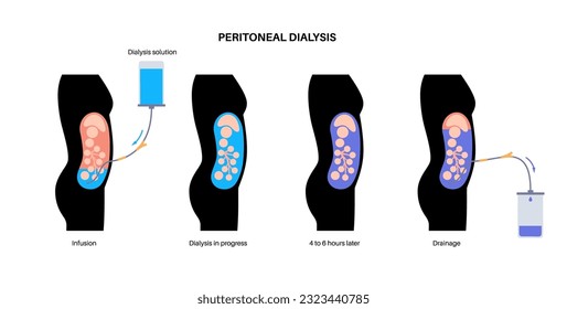Procedimiento de diálisis peritoneal. Fluido en cavidad peritoneal. Peritoneo en el abdomen, las sustancias se intercambian con la sangre. Tubo suave en el cuerpo humano, concepto catéter. Eliminar el exceso de líquido del vientre
