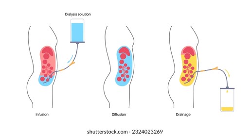 Procedimiento de diálisis peritoneal. Fluido en cavidad peritoneal. Peritoneo en el abdomen, las sustancias se intercambian con la sangre. Tubo suave en el cuerpo humano, concepto catéter. Eliminar el exceso de líquido del vientre