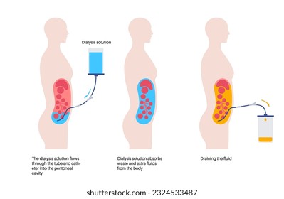 Procedimiento de diálisis peritoneal. Fluido en cavidad peritoneal. Peritoneo en el abdomen, las sustancias se intercambian con la sangre. Tubo suave en el cuerpo humano, concepto catéter. Eliminar el exceso de líquido del vientre