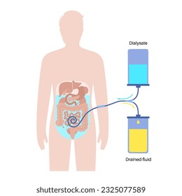 Procedimiento de diálisis peritoneal. Fluido en cavidad peritoneal. Peritoneo en el abdomen, las sustancias se intercambian con la sangre. Tubo suave en el cuerpo humano, concepto catéter. Eliminar el exceso de líquido del vientre