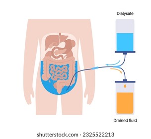 Procedimiento de diálisis peritoneal. Fluido en cavidad peritoneal. Peritoneo en el abdomen, las sustancias se intercambian con la sangre. Tubo suave en el cuerpo humano, concepto catéter. Eliminar el exceso de líquido del vientre