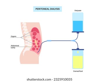 Procedimiento de diálisis peritoneal. Fluido en cavidad peritoneal. Peritoneo en el abdomen, las sustancias se intercambian con la sangre. Tubo suave en el cuerpo humano, concepto catéter. Eliminar el exceso de líquido del vientre