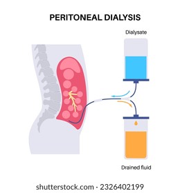 Procedimiento de diálisis peritoneal. Fluido en cavidad peritoneal. Peritoneo en el abdomen, las sustancias se intercambian con la sangre. Tubo suave en el cuerpo humano, concepto catéter. Eliminar el exceso de líquido del vientre