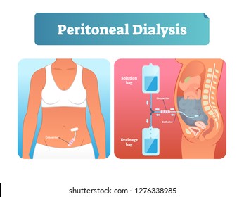 Peritoneal Dialysis Vector Illustration. Labeled Scheme With Method To Exchange Fluids After Surgery. Isolated Internal Catheter System Explanation Diagram. Medical Kidney Failure Solution Infographic