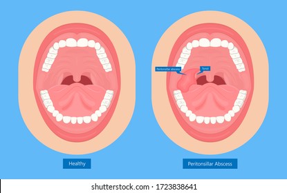 Peritonsillar Abscess bacterial infection throat tonsillitis pus  tonsil pain sore swollen