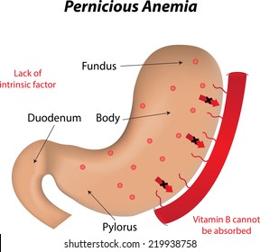 Pernicious Anemia