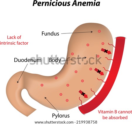 Pernicious Anemia