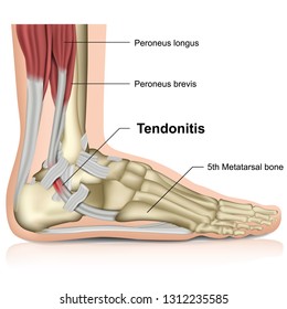 peroneal tendonitis ,ankle joint 3d medical vector illustration