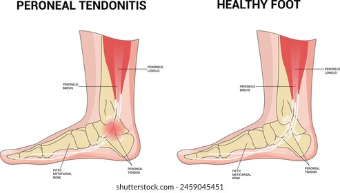 PERONEAL TENDONITIS Science Vector Illustration