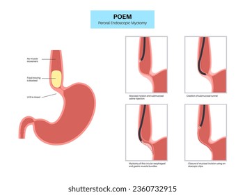 Peroral endoscopic myotomy. POEM minimally invasive procedure. Disorder of the esophagus, achalasia disease. Closed lower esophageal sphincter, gastroesophageal anatomical poster vector illustration