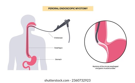 Peroral endoscopic myotomy. POEM minimally invasive procedure. Disorder of the esophagus, achalasia disease. Closed lower esophageal sphincter, gastroesophageal anatomical poster vector illustration