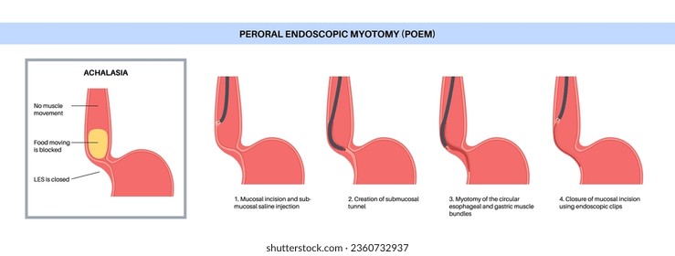 Peroral endoscopic myotomy. POEM minimally invasive procedure. Disorder of the esophagus, achalasia disease. Closed lower esophageal sphincter, gastroesophageal anatomical poster vector illustration