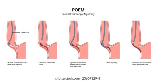 Peroral endoscopic myotomy. POEM minimally invasive procedure. Disorder of the esophagus, achalasia disease. Closed lower esophageal sphincter, gastroesophageal anatomical poster vector illustration