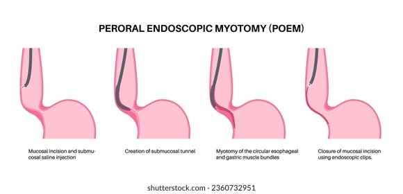 Peroral endoscopic myotomy. POEM minimally invasive procedure. Disorder of the esophagus, achalasia disease. Closed lower esophageal sphincter, gastroesophageal anatomical poster vector illustration